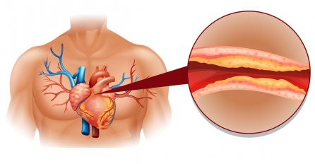 NAMIRNICA BROJ 1 ZA OBARANJE HOLESTEROLA: Čini čuda, a svima je dostupna 