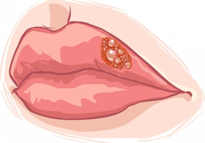 Prirodno izliječite herpes na usnama: Ovaj domaći lijek UBLAŽAVA BOL I UPALU