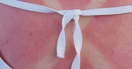 Dr Ivana Stefanović objasnila šta treba da uradite ako IZGORITE NA SUNCU: Evo šta trebate odmah namazati na tijelo