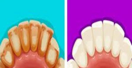 SAM SVOJ ZUBAR: 6 učinkovitih načina da se riješite zubnog kamenca