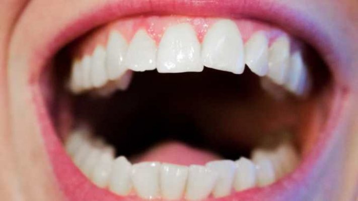 teeth-1652937-1280