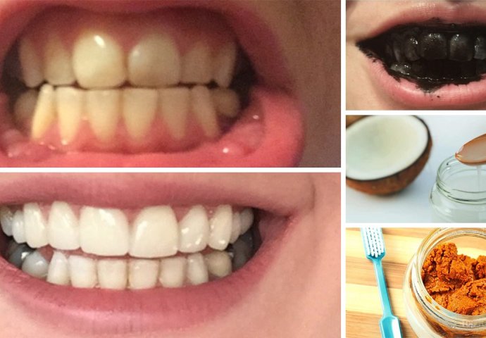 5 načina da brzo i jeftino izbijelite zube, namirnice već imate u kući!