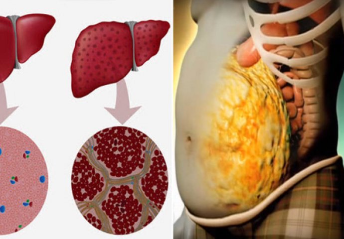 MOĆNI NAPITAK: Očistite jetru od toksina i masnoća i otarasite se viška kilograma