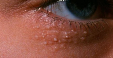 ZNATE LI KAKO SE UKLANJAJU MILIJE - BIJELE TAČKICE NA LICU: Ne smijete ih istiskivati, evo kako da nestanu