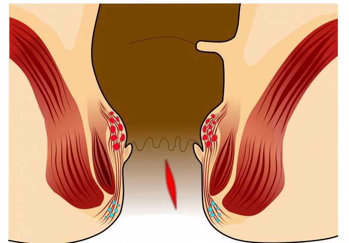BOLEST KOJE SE SRAMIMO: Šta uzrokuje analnu fisuru i kako je liječiti