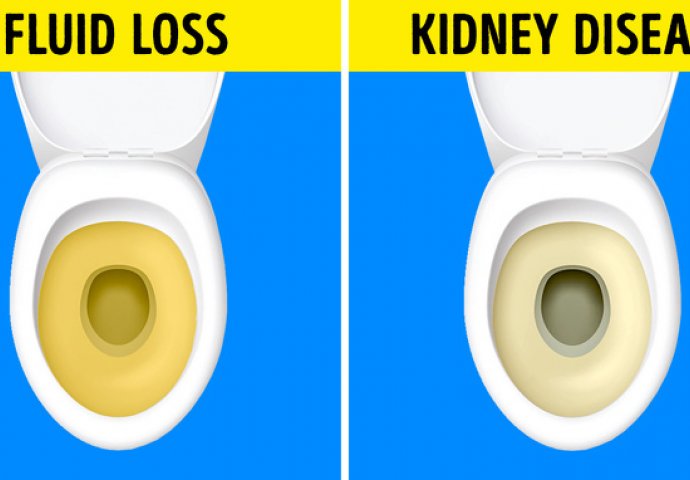 PROMJENA BOJE URINA, OSJEĆAJ NADUTOSTI: Ovih 7 znakova ukazuje da jedete previše soli