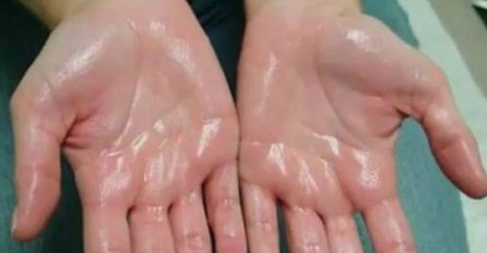 EVO ZBOG ČEGA VAM SE ZNOJE DLANOVI: Lijek možete pronaći u prirodi