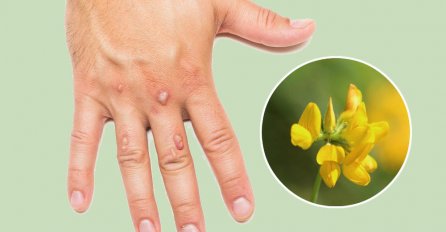 Bradavice će nestati nakon prvog nanošenja: Potreban vam je samo SOK OVE BILJKE!