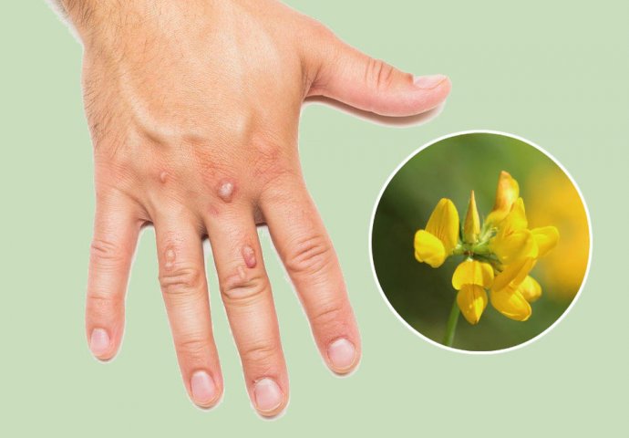 Bradavice će nestati nakon prvog nanošenja: Potreban vam je samo SOK OVE BILJKE!