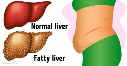 REKLI SU MI DA IMAM MASNU JETRU: Napravila sam ovaj PRIRODNI NAPITAK i očistila jetru u potpunosti! (RECEPT)