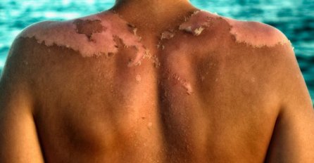 NAJBOLJI LIJEKOVI ZA OPEKOTINE OD SUNCA: Imate ih u kuhinji