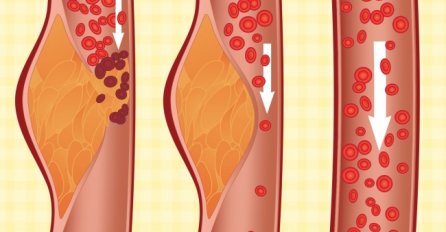DOKTORI TVRDE KAKO JE "DASH" DIJETA NAJBOLJA NA SVIJETU:  Smanjuje razinu holesterola, sprječava moždani udar i zatajenje srca I BIĆETE ZGODNIJI NEGO IKADA!