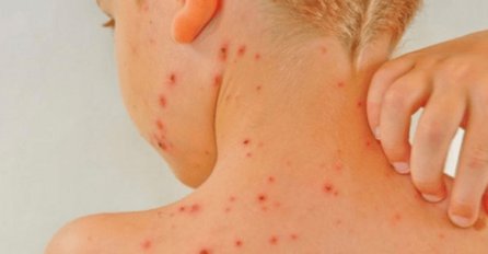 Tri nova slučaja morbila u Banjaluci