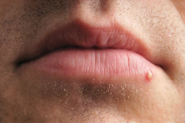 herpes-on-the-lips2