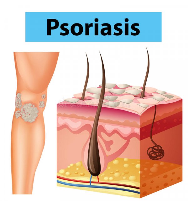 psorijaza2
