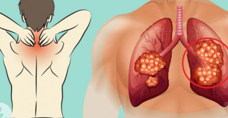 PREPOZNAJTE IH PRIJE NEGO BUDE KASNO: Ovi znakovi ukazuju na tumor pluća koje morate znati