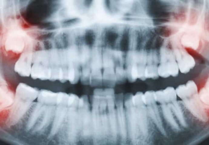 DJELUJE U TREN OKA: Najbolji prirodni lijek protiv zubobolje!