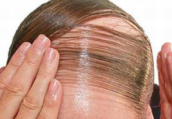 Bolna točka modernog muškarca: Lijek za ćelavost kod žena i muškaraca, kosa kao griva za samo mjesec dana! 