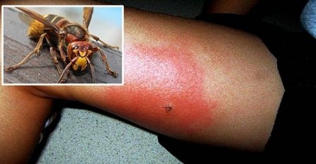 ZLU NE TREBALO: Ako vas ubode osa, stršljen ili pčela, ovo će vas spasiti bola i otoka