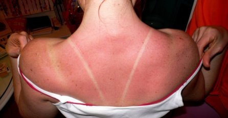 "JOGURT VAM NEĆE POMOĆI" Ova majka je odlučila da podijeli trik: Samo na ovaj način opekotine od sunca će nestati u TREN OKA