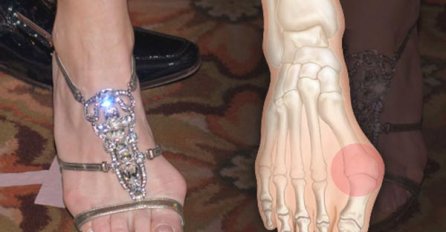 MNOGO ŽENA MUKU MUČI SA ČUKLJEVIMA: Evo šta ih uzrouje, a sa ovim NESTAJU KAO RUKOM ODNESENI!