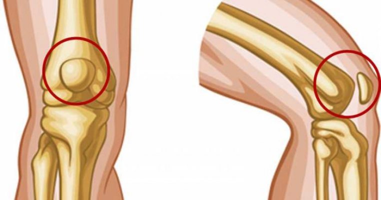 Bol u koljenima i ramenu: Postoji li poveznica i kako pristupiti liječenju? | missZDRAVA