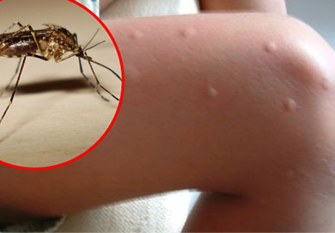 Komarci su vas 'pojeli'? Evo kako da se PRIRODNO ZAŠTITITE I UBLAŽITE SVRBEŽ!