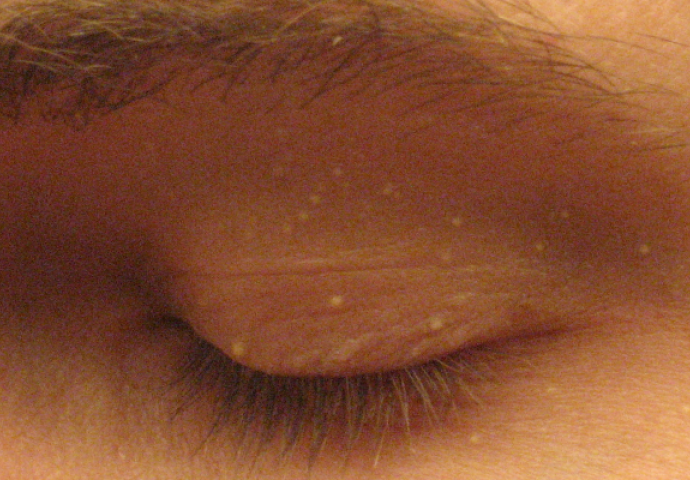 Bijele milie oko očiju mogu da TOLIKO utiču na naše zdravlje - Doktori nam ništa nisu rekli!