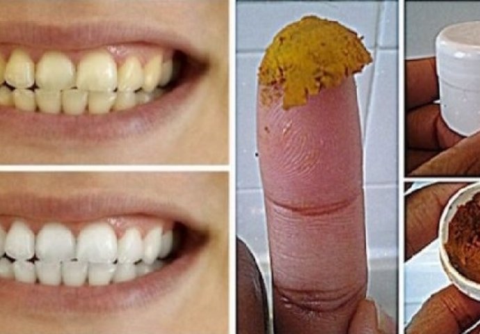 BISERNO BIJELI ZUBI: Izbijelite zube pomoću ova 3 sastojka koja već imate u kući 