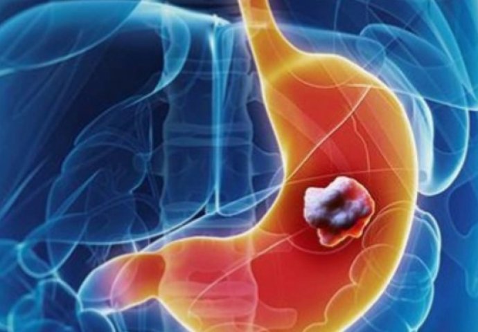 6 NAJRANIJIH SIMPTOMA RAKA ŽELUCA: Ovako tijelo šalje znak da se u organizmu razvija opaki tumor!