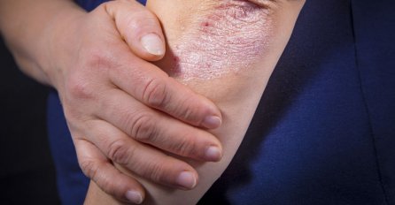 NIKAD VIŠE NEĆETE BACITI KORU OD OVE VOĆKE: Liječi psorijazu, skida bradavice, ALI TO NIJE SVE!