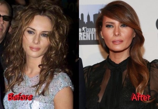 melania-trump-plastic-surgery-before-and-after