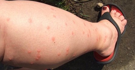 KOMARCI SU ME STALNO UJEDALI, DOK NISAM NAPRAVILA OVU SMJESU: Trebaju vam samo TRI SASTOJKA I ZAUVIJEK ĆE NESTATI!