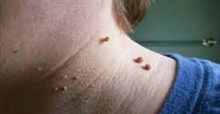 MUKU MUČITE SA VISEĆIM BRADAVICAMA: Ove metode će vam pomoći da ih uklonite