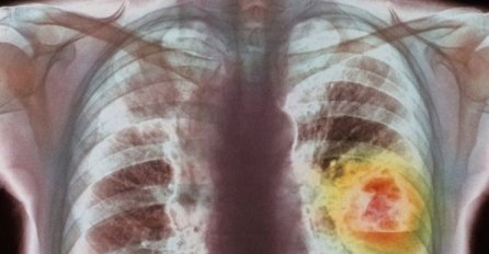 NJEMAČKI NOBELOVAC ZAPREPASTIO SVIJET: Rak se dobija od ove DVIJE NAMIRNICE, da su znali ljudi još bi bili živi