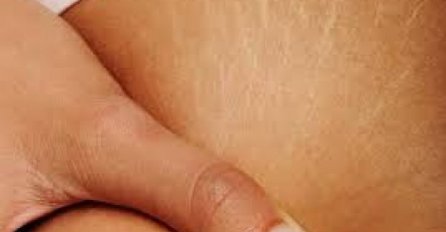 STRIJE ĆE POSTATI NEVIDLJIVE: 5 najboljih domaćih recepata, sve sastojke već imate, A STRIJE BRIŠE KAO OD ŠALE