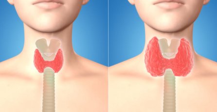 Rezultati vidljivi već nakon prve upotrebe: Ako imate problema sa ŠTITNOM ŽLIJEZDOM ovaj recept će vas spasiti!