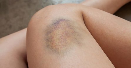 IMATE MODRICE PO TIJELU, A NISTE SE NIGDJE UDARILI? Ovih 5 signala ne smijete ignorisati, JEDAN JE KOBAN!