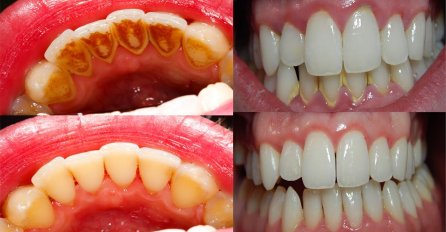 Bez odlaska zubaru: PLAK SA ZUBI uklonite u domu za samo 5 minuta! 