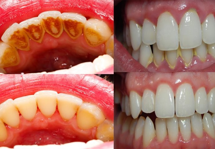 Bez odlaska zubaru: PLAK SA ZUBI uklonite u domu za samo 5 minuta! 