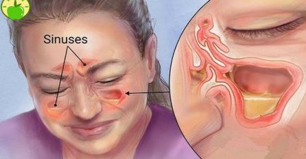 IZLIJEČITE SINUSNU INFEKCIJU ZA SVEGA NEKOLIKO SEKUNDI: Napravite ovaj domaći napitak i gledajte ČUDO!