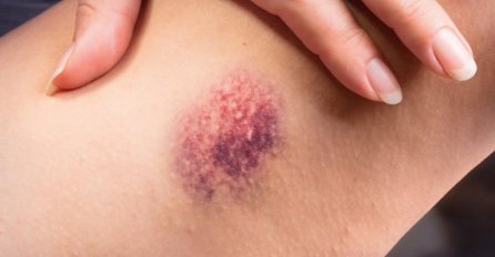 OVAKO IZGLEDA MISTERIOZNI SIMPTOM RAKA NA TIJELU: Ako vam se pojave i ovi simptomi, IMATE ZLOĆUDNU BOLEST!