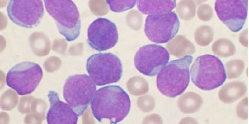 akutna-limfocitna-leukemija-580x290