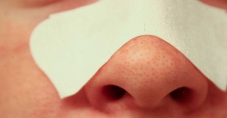 IMATE MITESERE NA NOSU? POMIJEŠAJTE OVA 2 SASTOJKA I NANESITE: Svi miteseri će nestati, a lice će vam biti blistavo čisto (RECEPT)