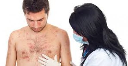 Rast broja oboljelih od boginja u Beču: Od januara do augusta četiri puta više oboljelih nego cijele prošle godine