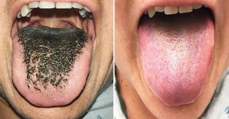 POPILA JE TABLETE KOJE MNOGI PIJU, A UJUTRO JOJ JE JEZIK BIO DLAKAV I CRN: Doktori su izdali OPASNO UPOZORENJE!