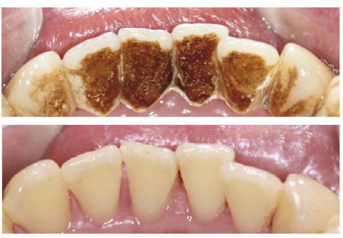 Muči li vas zubni kamenac: Sami ga uklonite za samo 5 minuta, NE TREBATE IĆI KOD ZUBARU