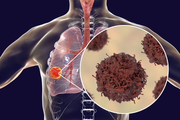 lung-cancer-tumor-inside-lung-235125739