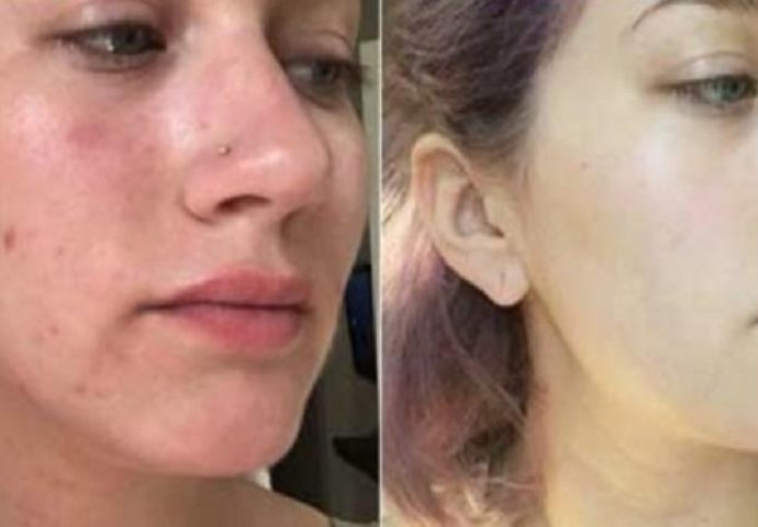 SVAKO JUTRA STAVLJA OVO NA LICE I REZULTATI SU IZNENAĐUJUĆI: Kad se pogleda u ogledalo NE MOŽE SE PREPOZNATI!