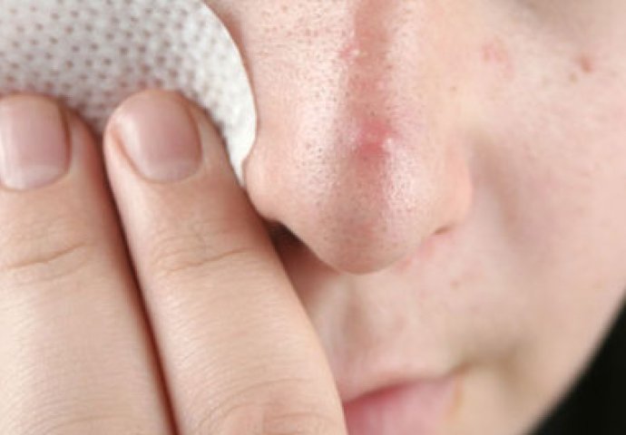NEVJEROVATNO ISTINITO: Šta akne, podočnjaci i crvenilo kože otkrivaju o zdravlju?